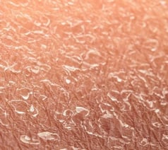 SCDON__What-Could-Be-Causing-Your-Dry-Skin
